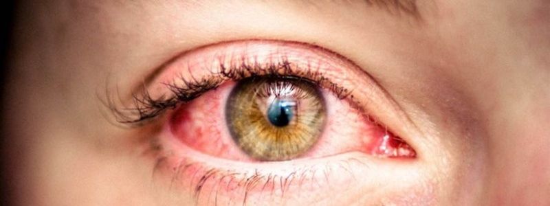 قرمزی چشم؛علل و درمان