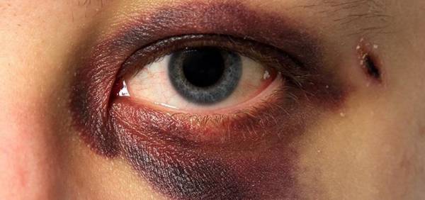 درمان کبودی چشم با ادویه مخصوص