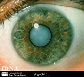خطر بیماری آب سیاه چشم در افراد بالای ۴۰ سال