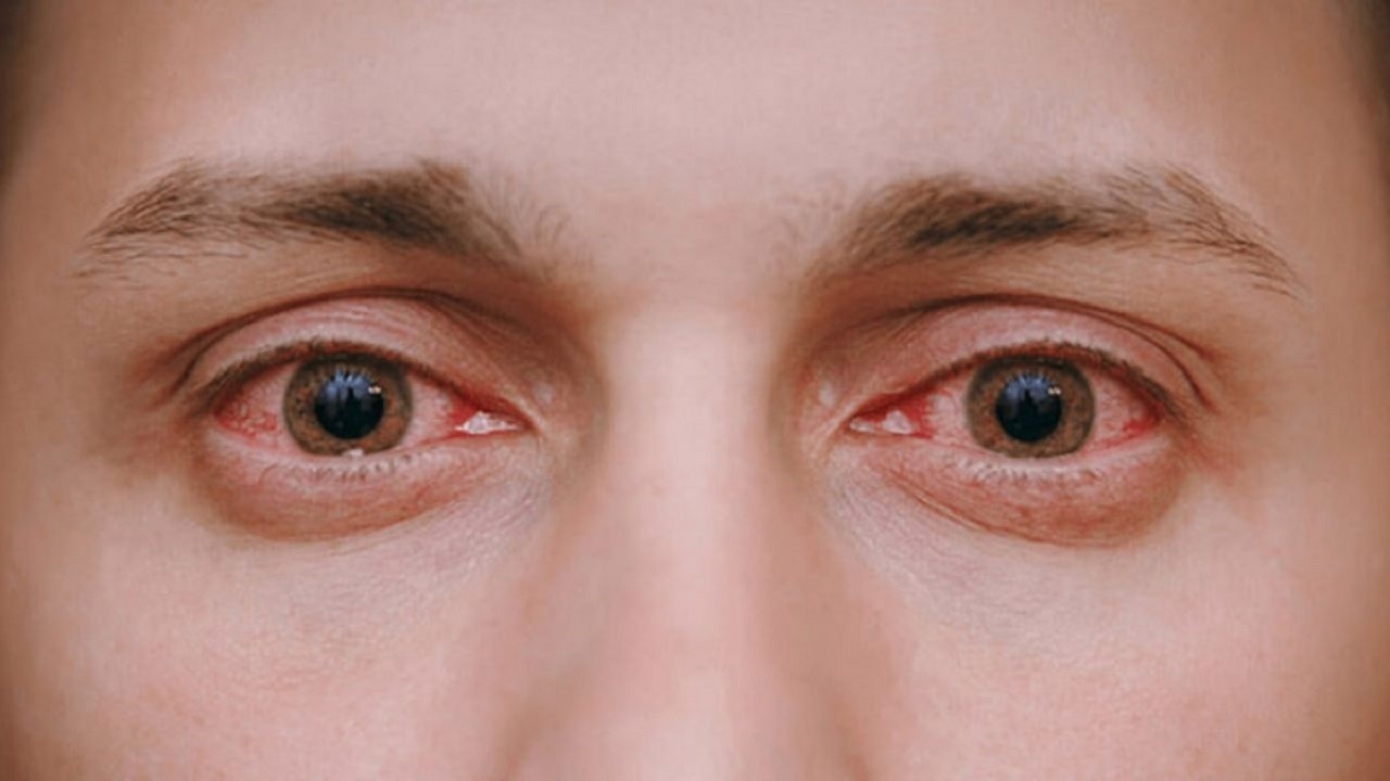 چهار دلیل اصلی قرمزی چشم و درمان آن