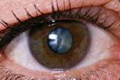 ابتلای ۲۰ درصدی تیروئیدی‌ها به علایم چشمی