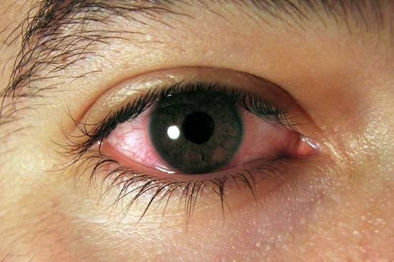 نعطیلی ۵۶ هزار مدرسه در پاکستان برای کنترل اپیدمی عفونت چشمی دانش آموزان