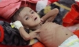 وضع فاجعه‌بار انسانی، مردم یمن را به زانو درآورده است
