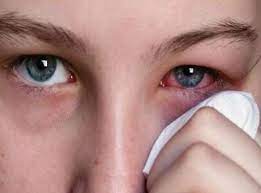 در هنگام آلودگی چشم با مواد شیمیایی چکار کنیم؟